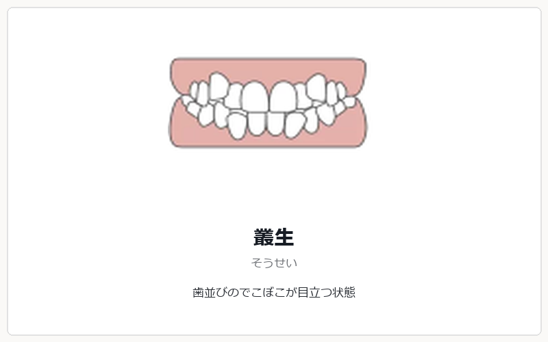 叢生の矯正治療