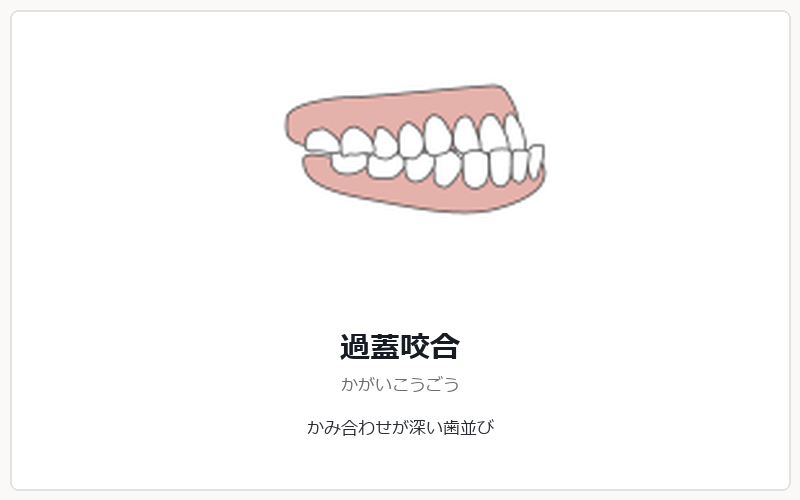 過蓋咬合の矯正治療
