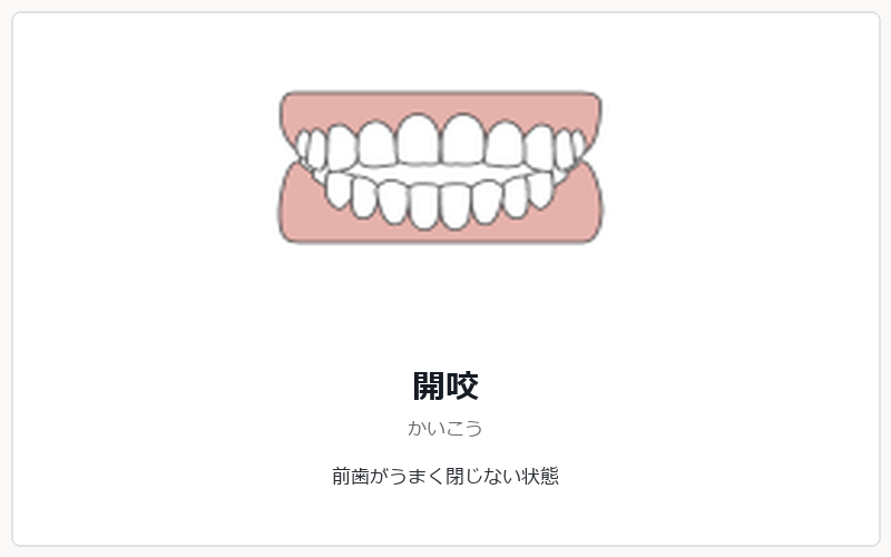 開咬の矯正治療