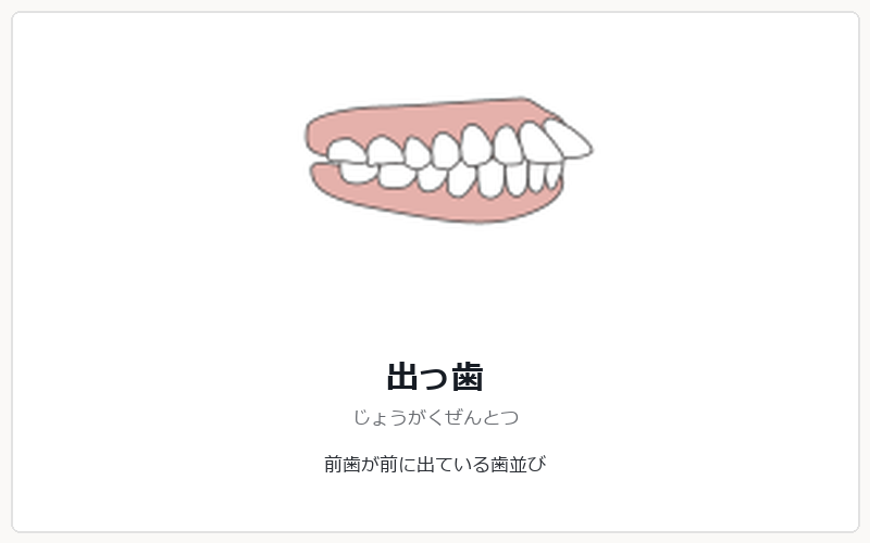 出っ歯の矯正治療
