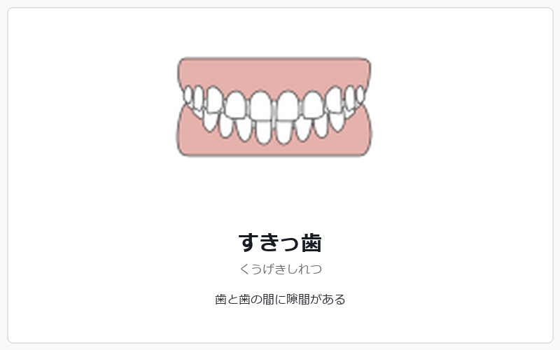 すきっ歯の矯正治療