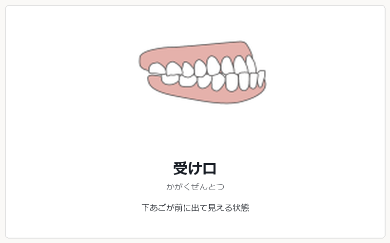 受け口の矯正治療
