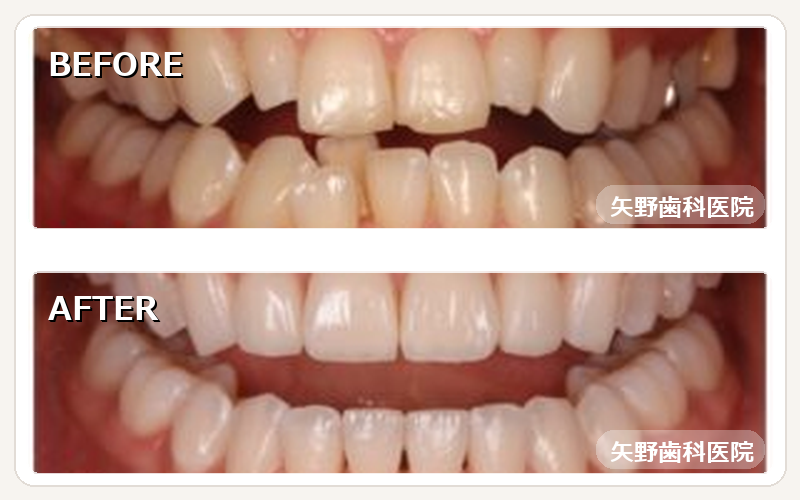 当院SMA（マウスピース矯正）治療例 Before After