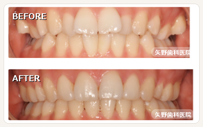 当院SMA（マウスピース矯正）治療例 Before After