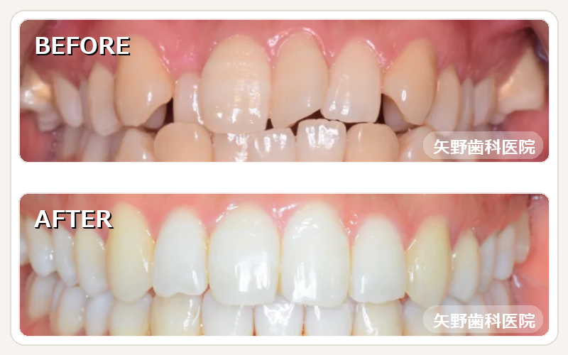当院SMA（マウスピース矯正）治療例 Before After